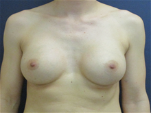 Breast Augmentation After Photo by Pramit Malhotra, MD; Ann Arbor, MI - Case 29913