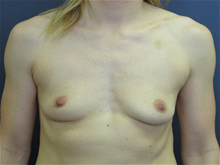 Breast Augmentation Before Photo by Pramit Malhotra, MD; Ann Arbor, MI - Case 29913