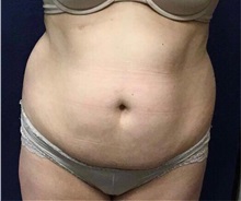 Tummy Tuck Before Photo by Pramit Malhotra, MD; Ann Arbor, MI - Case 35696