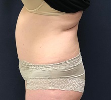 Tummy Tuck After Photo by Pramit Malhotra, MD; Ann Arbor, MI - Case 35696
