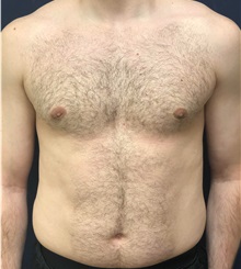 Male Breast Reduction After Photo by Pramit Malhotra, MD; Ann Arbor, MI - Case 35698