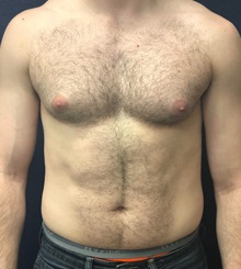 Male Breast Reduction Before Photo by Pramit Malhotra, MD; Ann Arbor, MI - Case 35698