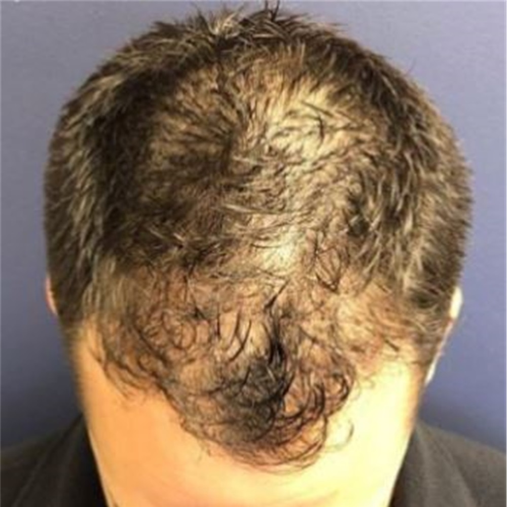 Hair Transplant Before and After Photos by Pramit Malhotra, MD; Ann Arbor,  MI - Case 37961 | ASPS