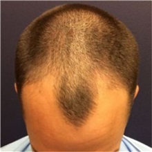 Hair Transplant Before Photo by Pramit Malhotra, MD; Ann Arbor, MI - Case 37961