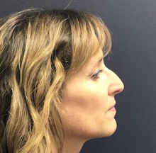 Rhinoplasty Before Photo by Pramit Malhotra, MD; Ann Arbor, MI - Case 37967