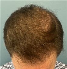 Hair Transplant After Photo by Pramit Malhotra, MD; Ann Arbor, MI - Case 50401
