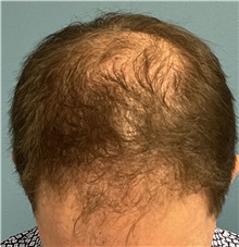 Hair Transplant Before Photo by Pramit Malhotra, MD; Ann Arbor, MI - Case 50401