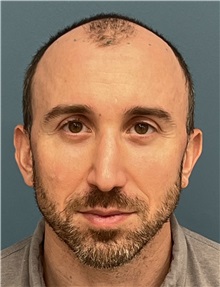 Hair Transplant Before Photo by Pramit Malhotra, MD; Ann Arbor, MI - Case 50398