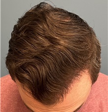 Hair Transplant After Photo by Pramit Malhotra, MD; Ann Arbor, MI - Case 50398