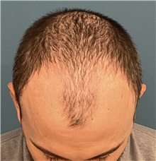 Hair Transplant Before Photo by Pramit Malhotra, MD; Ann Arbor, MI - Case 50398