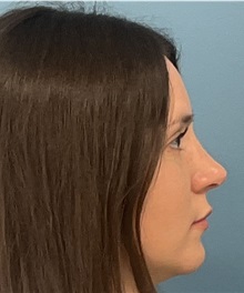 Rhinoplasty After Photo by Pramit Malhotra, MD; Ann Arbor, MI - Case 50403
