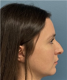 Rhinoplasty Before Photo by Pramit Malhotra, MD; Ann Arbor, MI - Case 50403