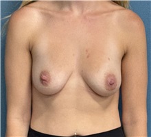 Breast Augmentation Before Photo by Pramit Malhotra, MD; Ann Arbor, MI - Case 50405