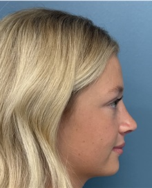 Rhinoplasty After Photo by Pramit Malhotra, MD; Ann Arbor, MI - Case 50404