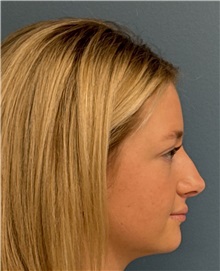 Rhinoplasty Before Photo by Pramit Malhotra, MD; Ann Arbor, MI - Case 50404