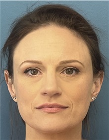 Rhinoplasty After Photo by Pramit Malhotra, MD; Ann Arbor, MI - Case 50402