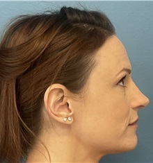 Rhinoplasty After Photo by Pramit Malhotra, MD; Ann Arbor, MI - Case 50402