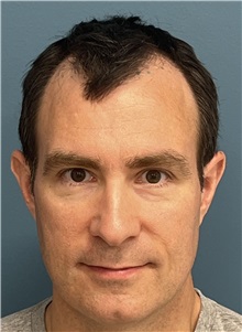 Hair Transplant Before Photo by Pramit Malhotra, MD; Ann Arbor, MI - Case 50399