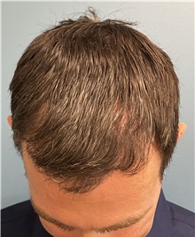 Hair Transplant After Photo by Pramit Malhotra, MD; Ann Arbor, MI - Case 50399