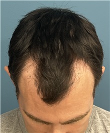 Hair Transplant Before Photo by Pramit Malhotra, MD; Ann Arbor, MI - Case 50399