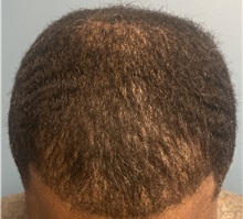 Hair Transplant After Photo by Pramit Malhotra, MD; Ann Arbor, MI - Case 50400