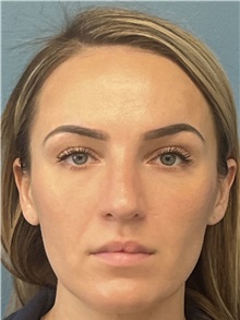 Rhinoplasty After Photo by Pramit Malhotra, MD; Ann Arbor, MI - Case 50410