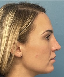 Rhinoplasty After Photo by Pramit Malhotra, MD; Ann Arbor, MI - Case 50410