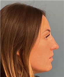 Rhinoplasty Before Photo by Pramit Malhotra, MD; Ann Arbor, MI - Case 50410