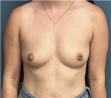 Breast Augmentation Before Photo by Pramit Malhotra, MD; Ann Arbor, MI - Case 50407