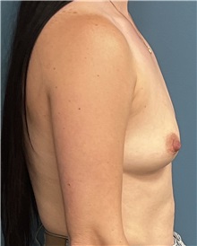 Breast Augmentation Before Photo by Pramit Malhotra, MD; Ann Arbor, MI - Case 50407