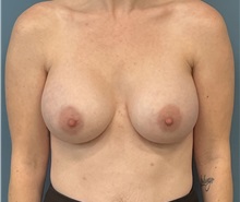 Breast Augmentation After Photo by Pramit Malhotra, MD; Ann Arbor, MI - Case 50406