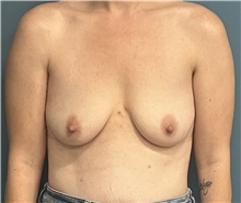 Breast Augmentation Before Photo by Pramit Malhotra, MD; Ann Arbor, MI - Case 50406