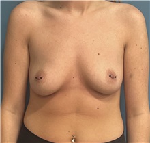 Breast Augmentation Before Photo by Pramit Malhotra, MD; Ann Arbor, MI - Case 50412