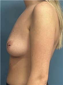 Breast Augmentation Before Photo by Pramit Malhotra, MD; Ann Arbor, MI - Case 50412