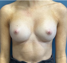 Breast Augmentation After Photo by Pramit Malhotra, MD; Ann Arbor, MI - Case 50409