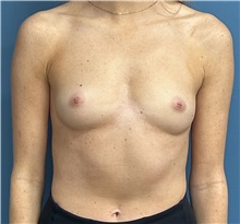 Breast Augmentation Before Photo by Pramit Malhotra, MD; Ann Arbor, MI - Case 50409