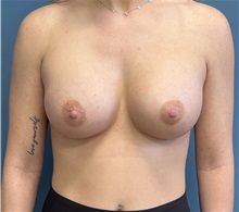 Breast Augmentation After Photo by Pramit Malhotra, MD; Ann Arbor, MI - Case 50411
