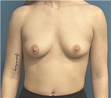 Breast Augmentation Before Photo by Pramit Malhotra, MD; Ann Arbor, MI - Case 50411