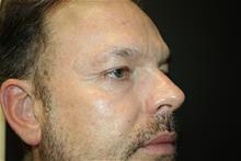 Skin rejuvenation and resurfacing After Photo by Jaime Schwartz, MD; Beverly Hills, CA - Case 29794