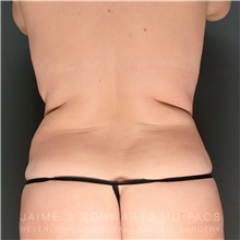 Body Lift Before Photo by Jaime Schwartz, MD; Beverly Hills, CA - Case 31033