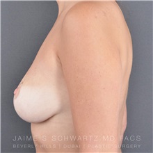 Breast Lift After Photo by Jaime Schwartz, MD; Beverly Hills, CA - Case 31036