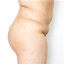 Buttock Implants After Photo by Jaime Schwartz, MD; Beverly Hills, CA - Case 31037