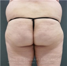 Buttock Implants Before Photo by Jaime Schwartz, MD; Beverly Hills, CA - Case 31037