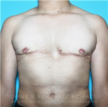 Male Breast Reduction After Photo by Jaime Schwartz, MD; Beverly Hills, CA - Case 31039