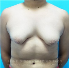 Male Breast Reduction Before Photo by Jaime Schwartz, MD; Beverly Hills, CA - Case 31039