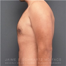 Male Breast Reduction After Photo by Jaime Schwartz, MD; Beverly Hills, CA - Case 31040