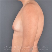 Male Breast Reduction Before Photo by Jaime Schwartz, MD; Beverly Hills, CA - Case 31040