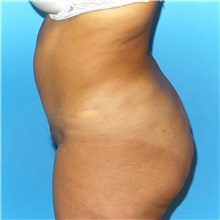 Tummy Tuck After Photo by Jaime Schwartz, MD; Beverly Hills, CA - Case 31068