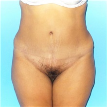 Tummy Tuck After Photo by Jaime Schwartz, MD; Beverly Hills, CA - Case 31068