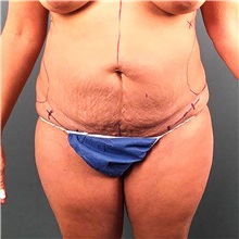 Tummy Tuck Before Photo by Jaime Schwartz, MD; Beverly Hills, CA - Case 31068